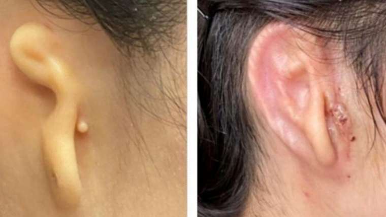Woman gets 3D printed ear Transplant made of her own cells