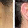 Woman gets 3D printed ear Transplant made of her own cells